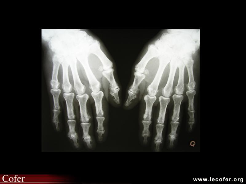 Rhumatisme psoriasique