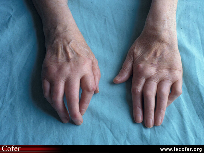 Polyarthrite rhumatoïde, PR ; atteinte des doigts : amyotrophie des interosseux