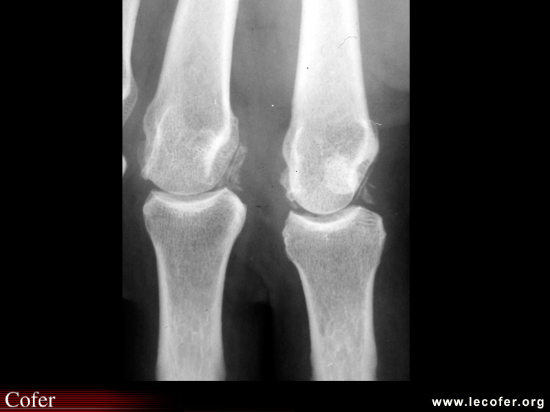 Chondrocalcinose : atteinte des métacarpo-phalangiennes