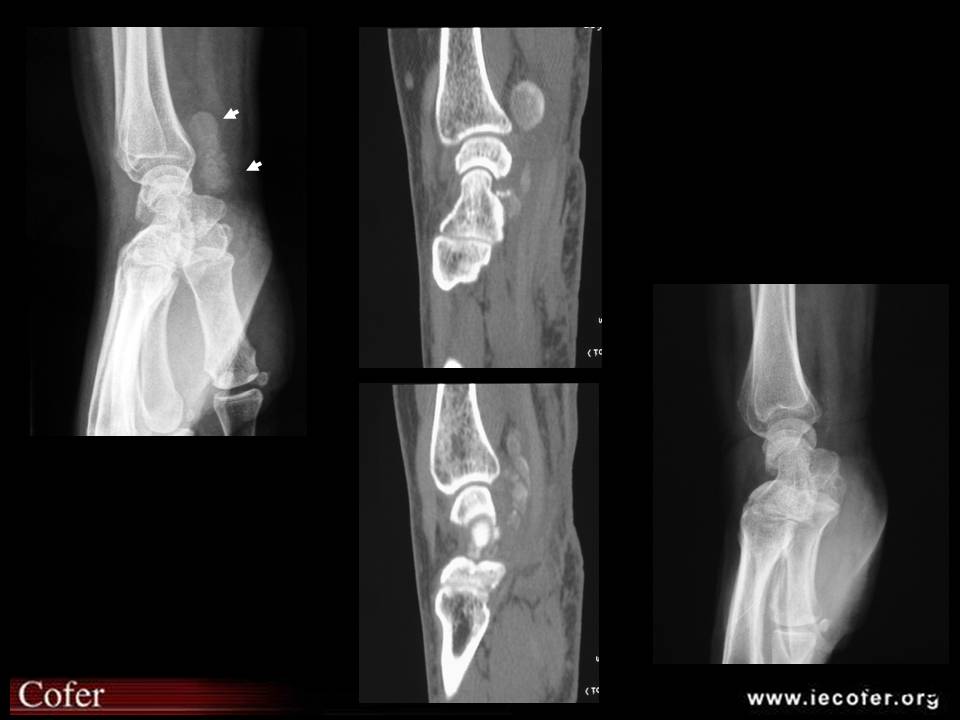 calcification tendineuse des fléchisseurs de la main