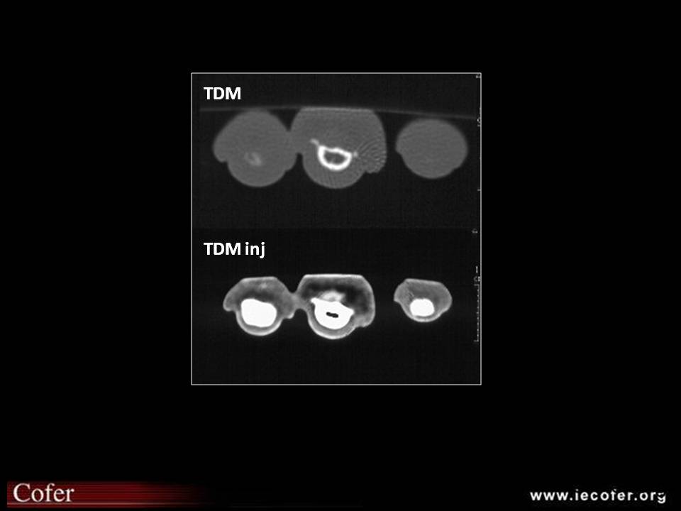 Tumeur glomique du doigt: TDM