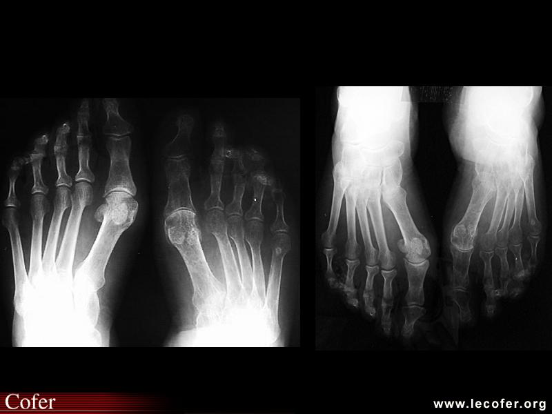 Algoneurodystrophie, algodystrophie du pied : radiographies