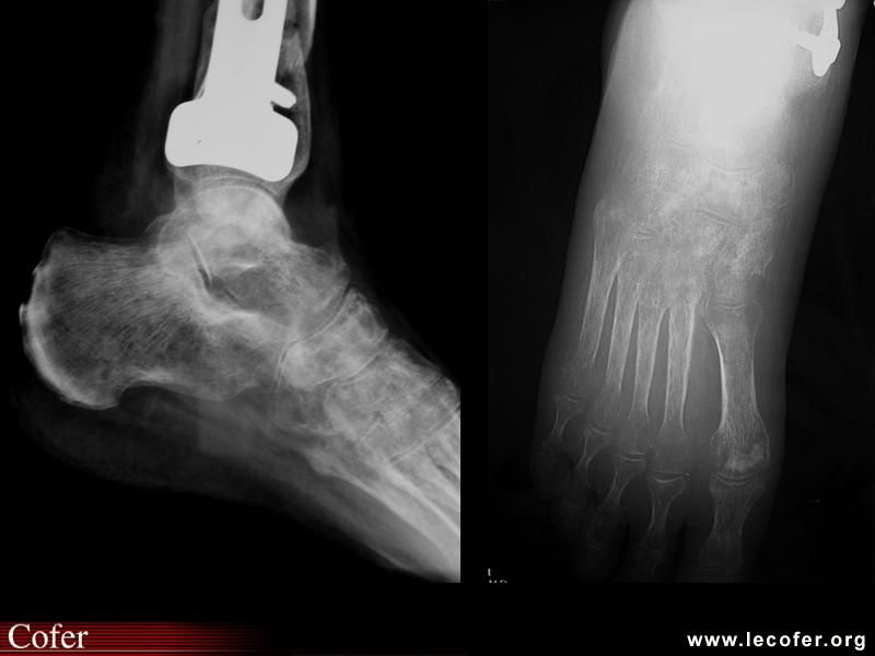 Algodystophie, algoneurodystrophie du pied : aspect radiologique