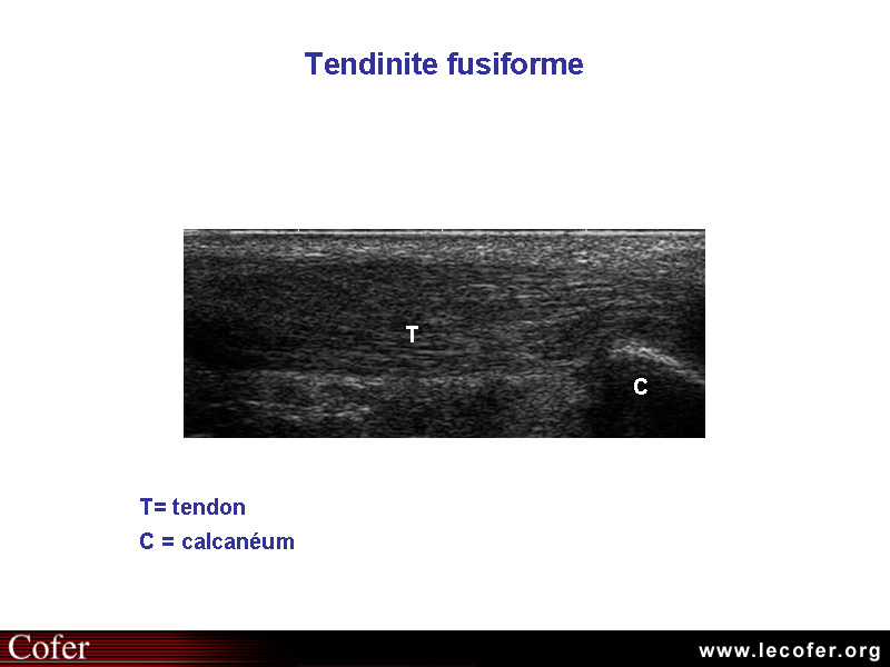 Tendinite du tendon d'Achille, échographie