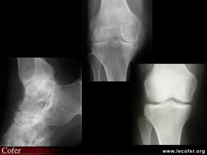 Spondylarthrite ankylosante / SpA / pelvispondylite rhumatismale / spondylarthropathie : atteinte des pieds et des genoux