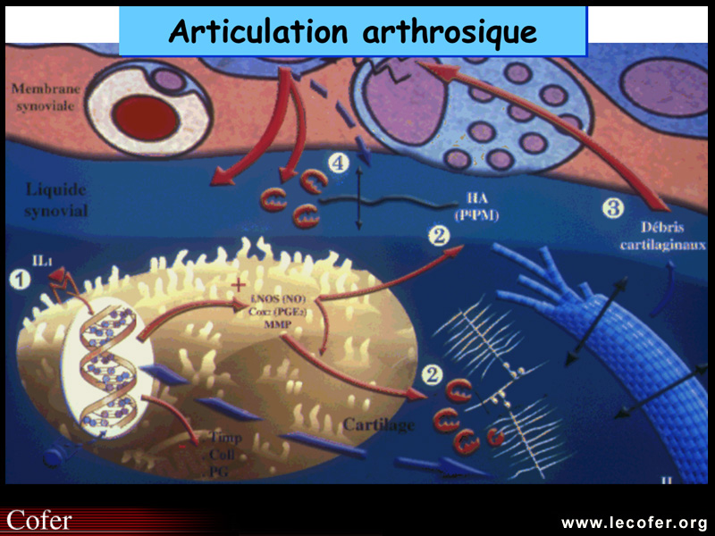 Physiopathologie de l'arthrose : balance entre les mécanismes de destruction et de réparation du cartilage