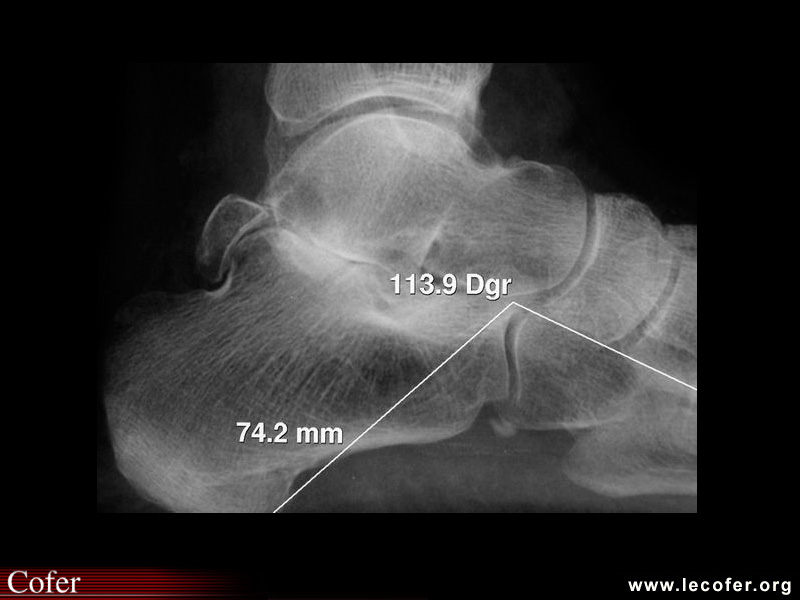 Arthrose du médiopied