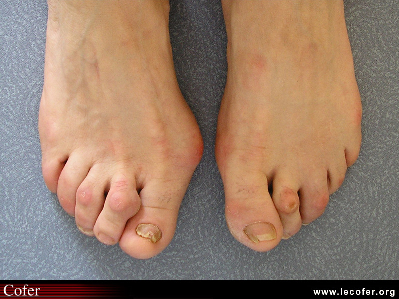 Hallux valgus avec syndrome du deuxième rayon