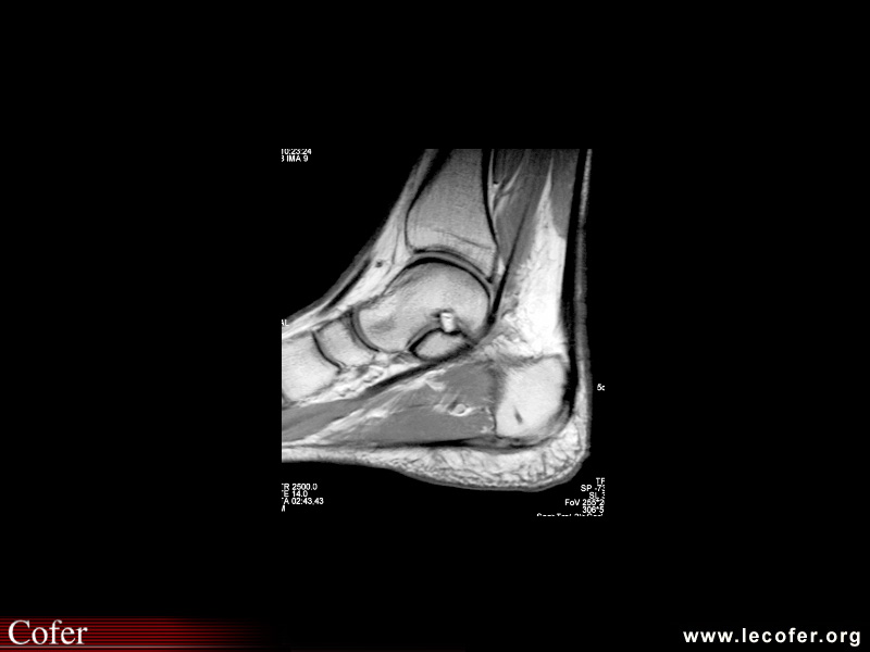 Rupture de l’aponévrose plantaire (IRM)