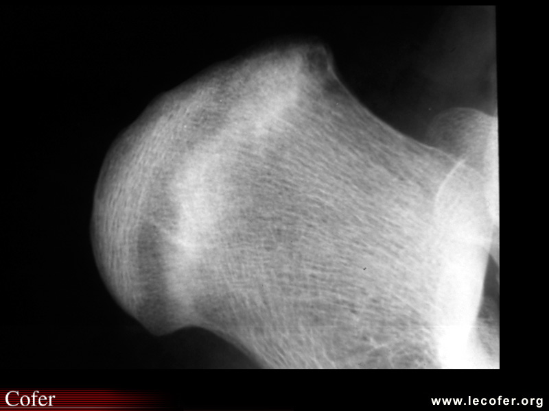 Fracture de fatigue, fissure de fatigue du calcanéum