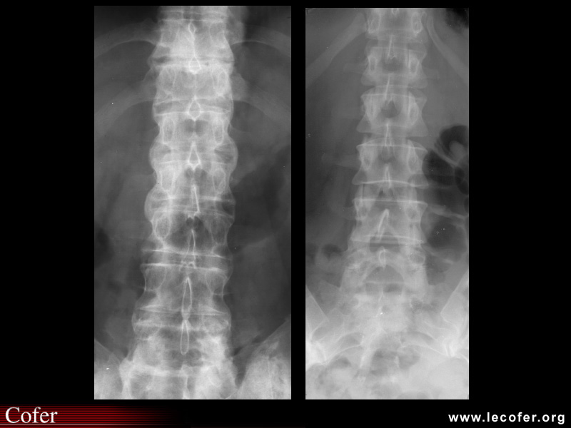 Spondylarthrite ankylosante / SpA / pelvispondylite rhumatismale / spondylarthropathie : syndesmophytose étendue de face