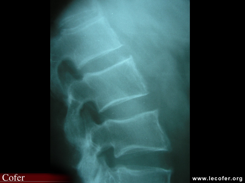 Spondylarthrite ankylosante / SpA / pelvispondylite rhumatismale / spondylarthropathie : mise au carré des vertèbres
