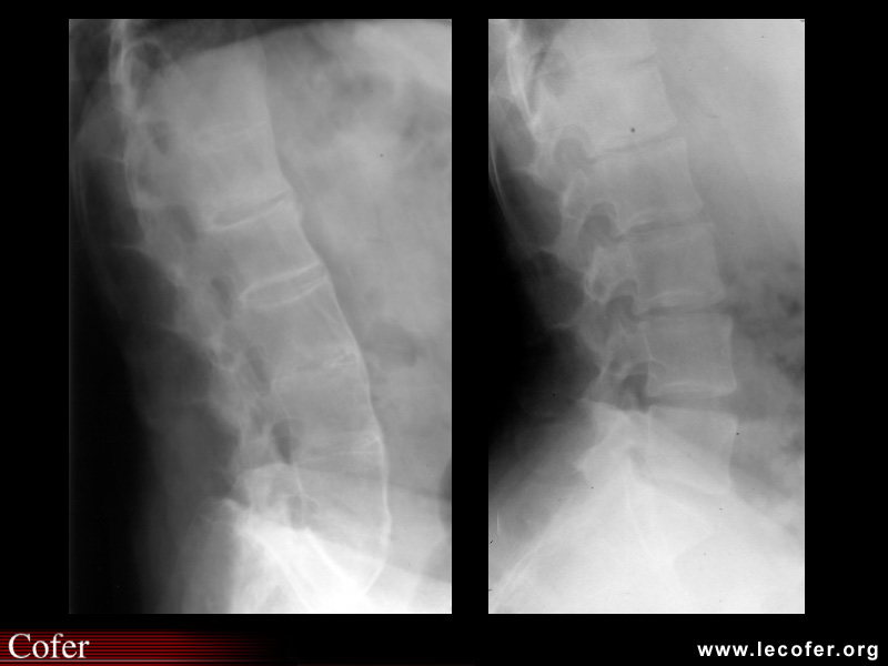 Spondylarthrite ankylosante / SpA / pelvispondylite rhumatismale / spondylarthropathie