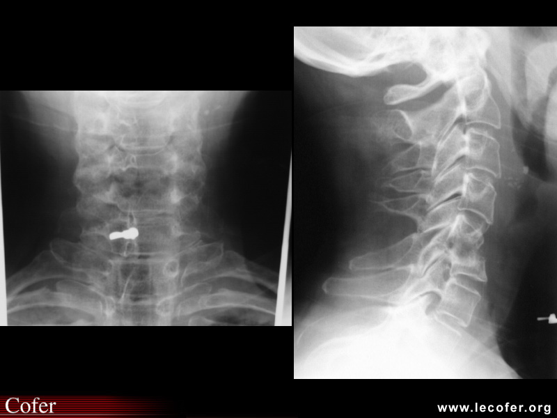 Spondylodiscite infectieuse avec ostéolyse vertébrale