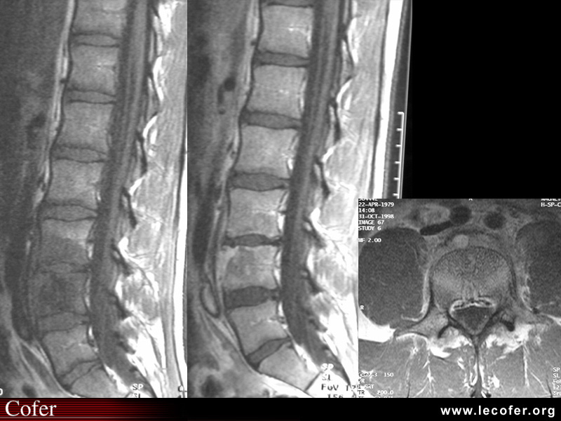 Spondylite infectieuse à pyogènes, spondylodiscite infectieuse