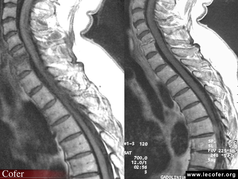 Spondylodiscite infectieuse, spondylodiscite infectieuse traitée depuis 2 mois, spondylodiscite infectieuse