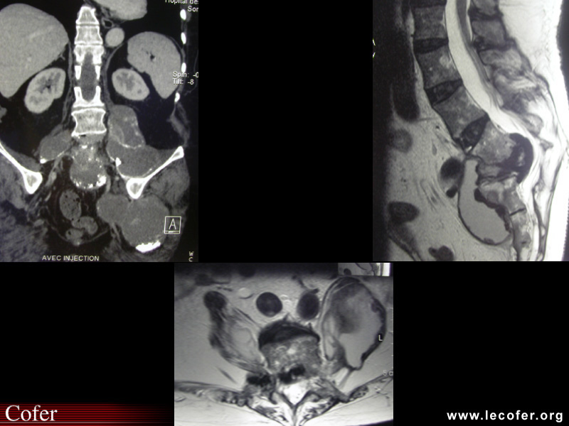 Mal de Pott, tuberculose vertébrale, tuberculose ostéoarticulaire