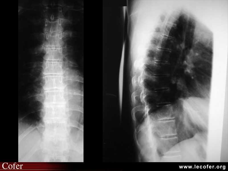 Radiographies normales du rachis dorsal (face et profil)