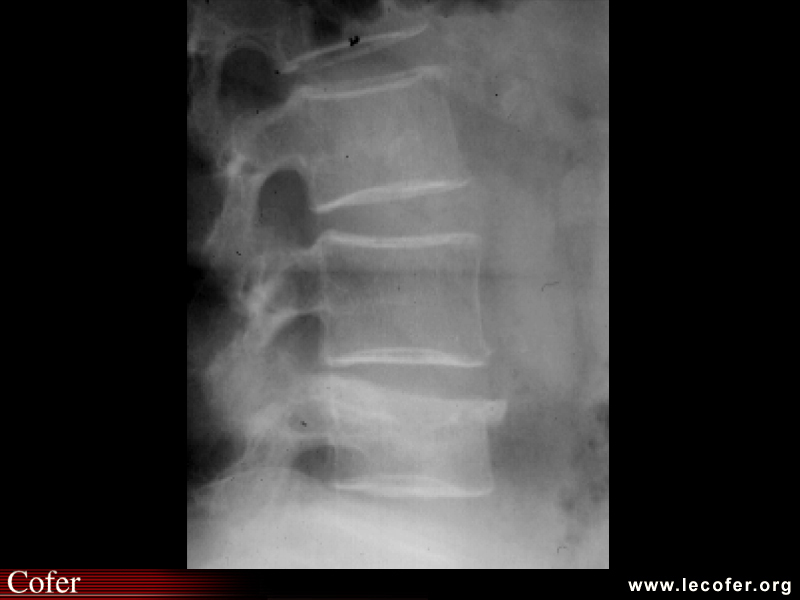 Fracture vertébrale de grade 2 du rachis lombaire