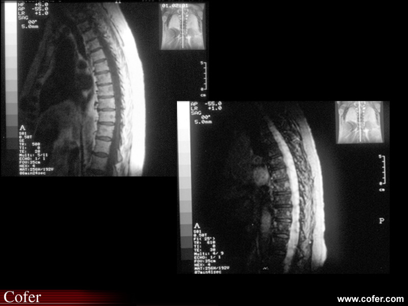 Myélome multiple : IRM : atteinte nodulaire des corps vertébraux