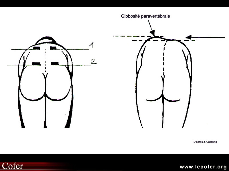 Scoliose et attitude scoliotique