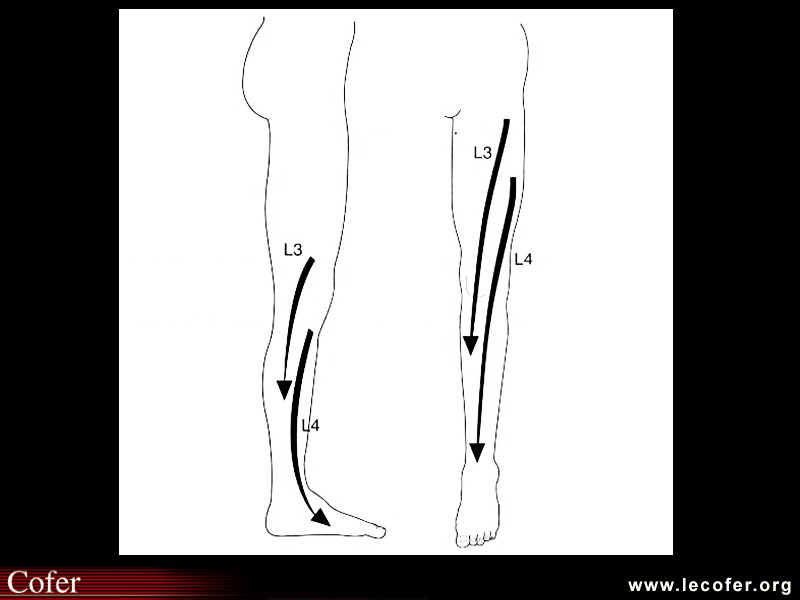 Cruralgie L3 L4 , lomboradiculalgie, lombocruralgie