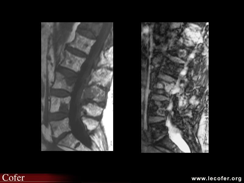 Métastase osseuse, métastases : cancer du sein (IRM)