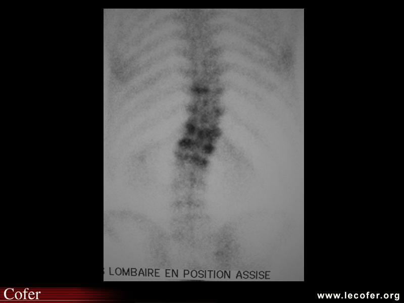 Métastases rachidiennes (scintigraphie osseuse)