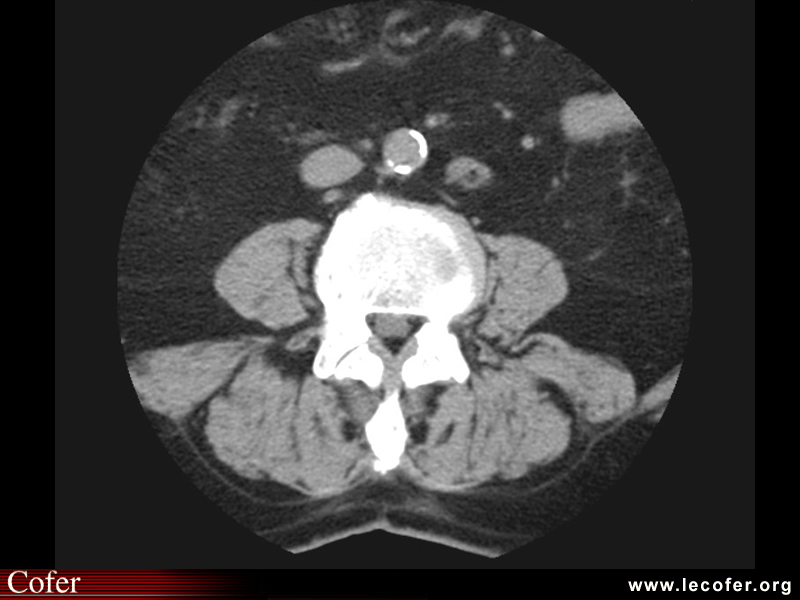 Lipomatose épidurale : scanner