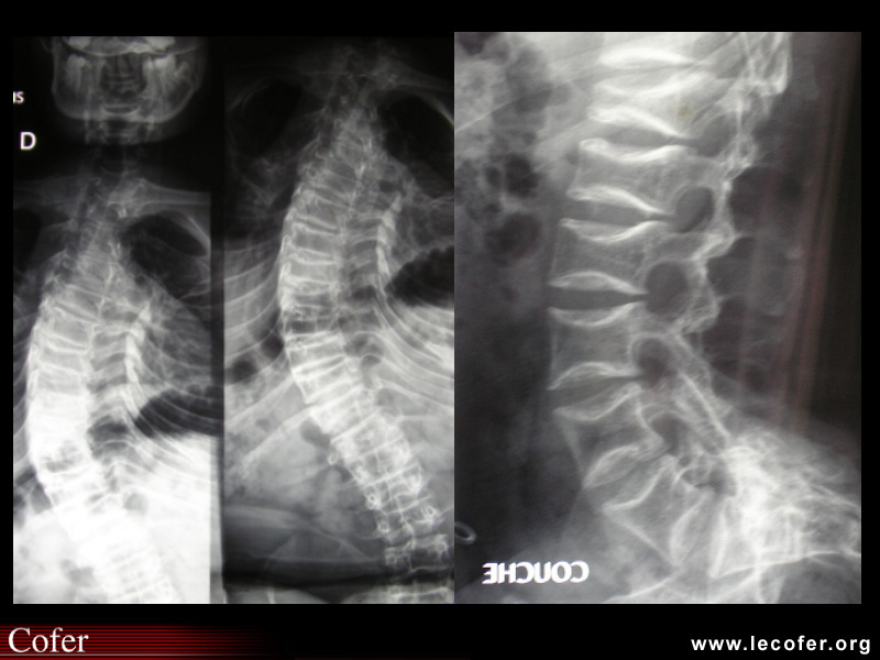Ostéogenèse imparfaite : rachis