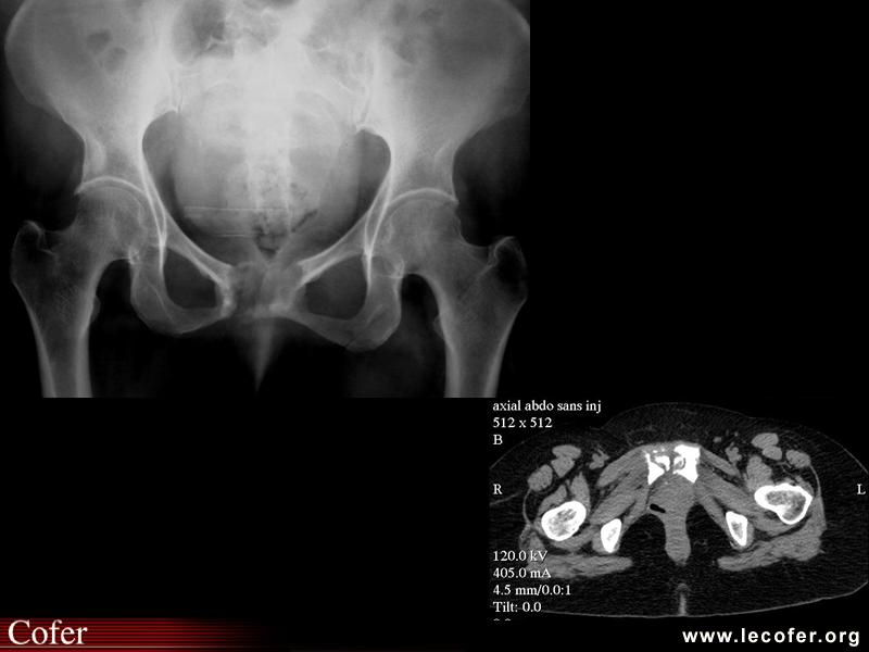 Arthrite tuberculeuse de la symphyse pubienne