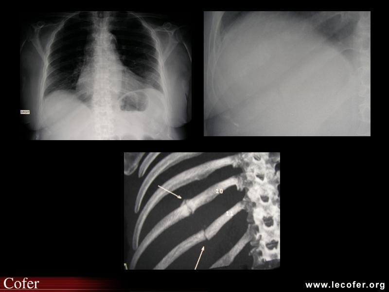 Ostéoporose, fracture de côtes, fracture de côtes d’origine ostéoporotique