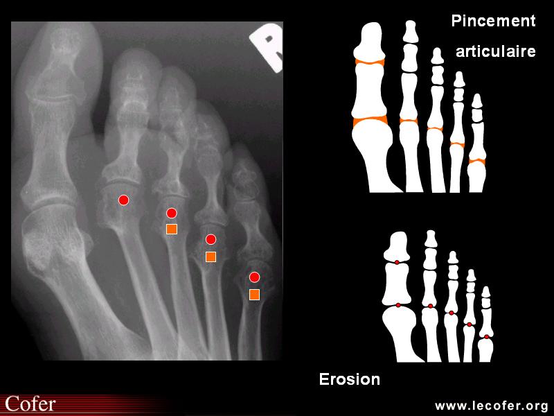 Score radiologique de SENS dans la polyarthrite rhumatoïde