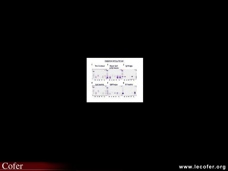 Immunofixation des protéines sériques