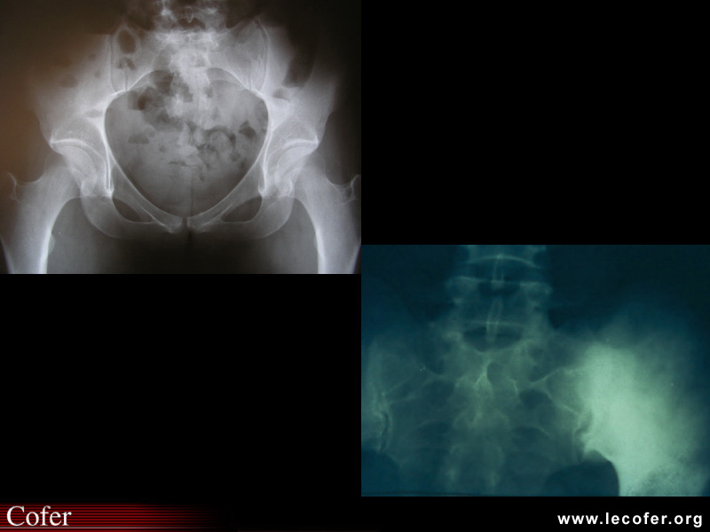 Spondylarthrite ankylosante / SpA / pelvispondylite rhumatismale / spondylarthropathie : Comparatif ostéose iliaque condensante