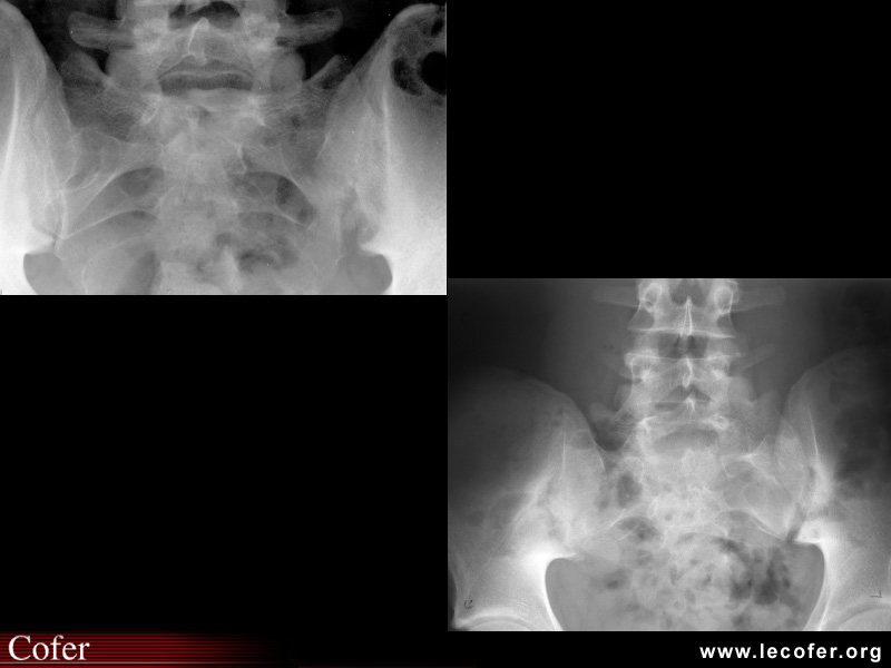 Spondylarthrite ankylosante / SpA / pelvispondylite rhumatismale / spondylarthropathie : diagnostic différentiel