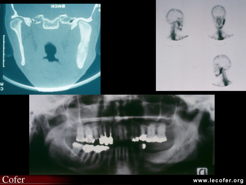 SAPHO : Ostéite mandibulaire de type SAPHO