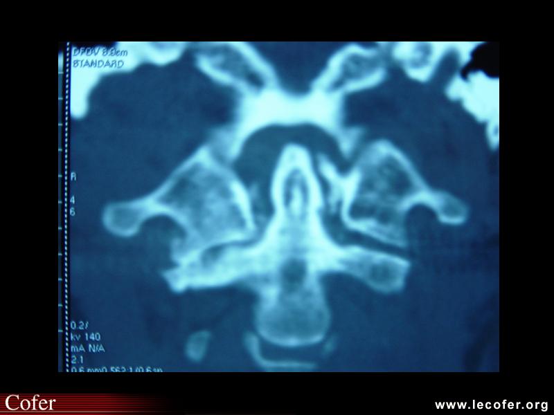 Chondrocalcinose articulaire, syndrome de la dent couronnée