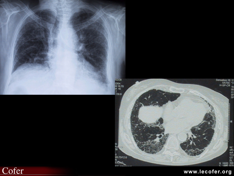 Sclérodermie systémique : Atteinte pulmonaire