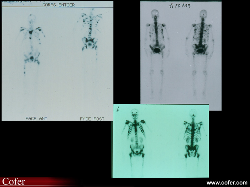 Métastases osseuses:scintigraphie squelettique au cours des métastases osseuses