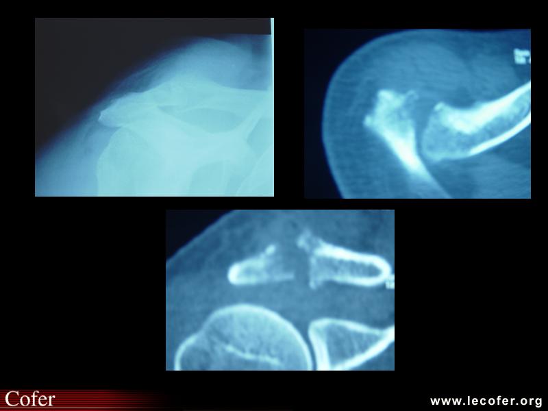 Arthrite acromio-claviculaire