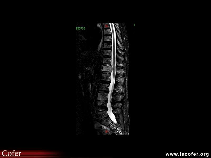Myélome multiple, aspect IRM du rachis dans le myélome multiple