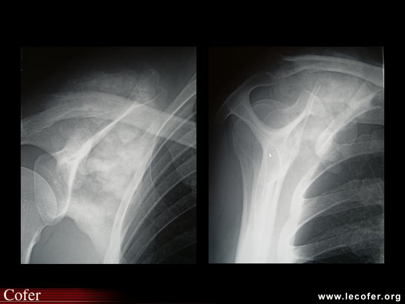 Insuffisance rénale chronique, calcification pseudo-tumorale de l’épaule