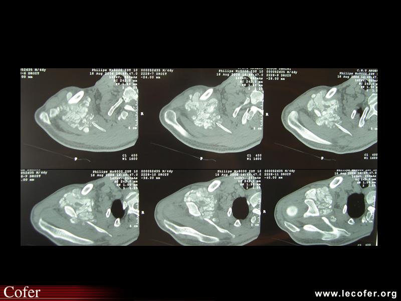 Insuffisance rénale chronique, calcification pseudo-tumorale de l’épaule