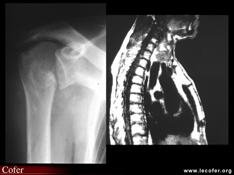 Syringomyélie – arthropathie nerveuse