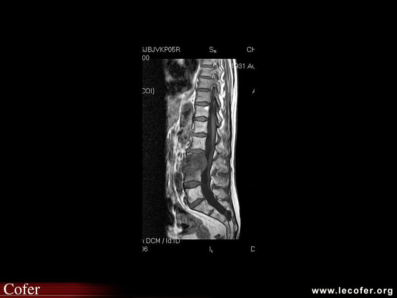 Spondylodiscite à staphylococcus aureus