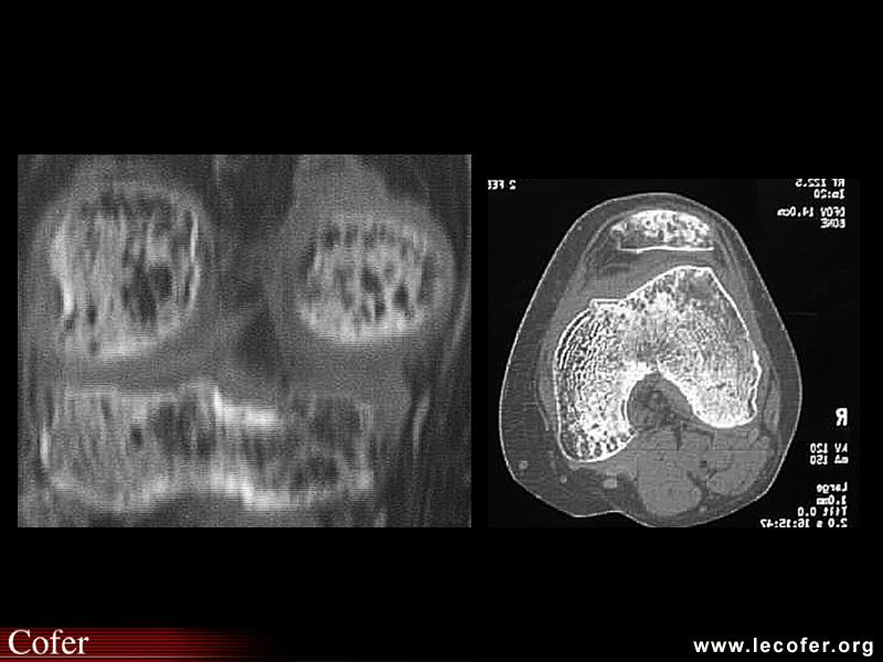 Algoneurodystrophie, algodystrophie du genou : TDM