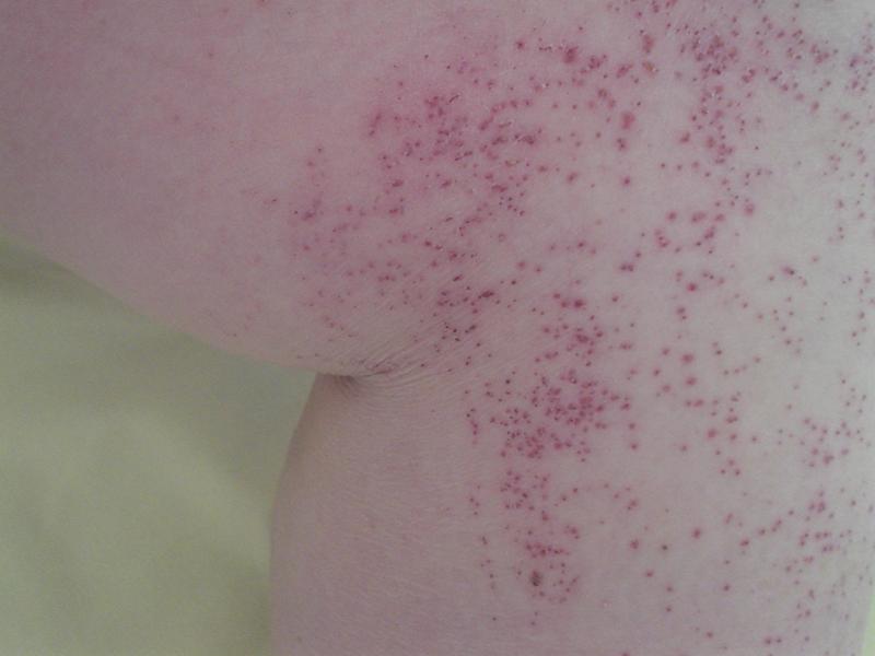 Purpura rhumatoïde