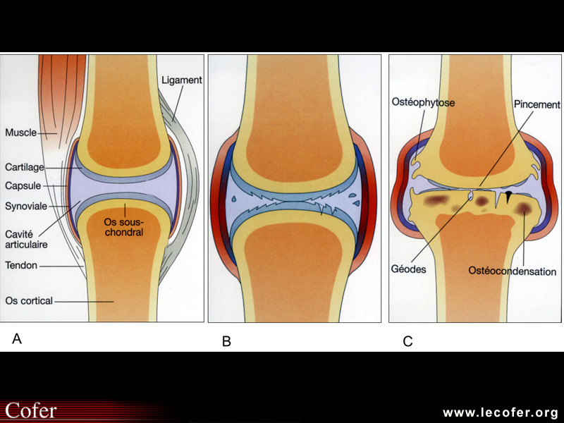 Arthrose: articulation normale vs pathologique