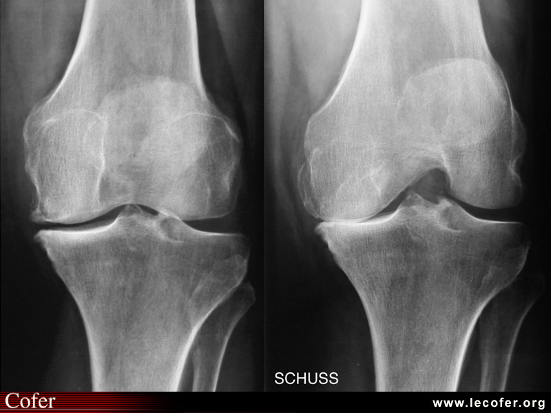 Gonarthrose: intérêt du schuss.